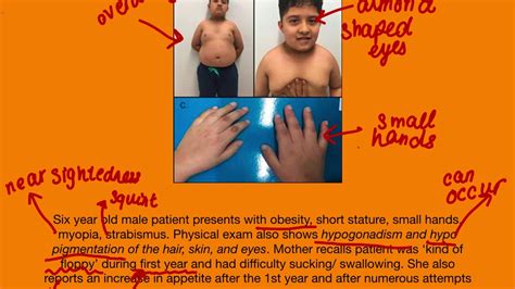 prada willi case-study year-old|prader willi syndrome.